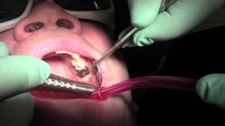 Canker sore treatment and relief at Sana Dental in Edmonton [upl. by Maurita]