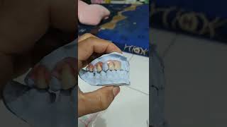 Denture valspatdentist gigitiruan dentalprosthesis gigitan doktergigi vidioshorts [upl. by Dorothy357]