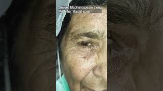 Blepharospasm along with hemifacial spasm [upl. by Carbo]