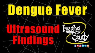 Dengue Fever  Ultrasound  Case 130 [upl. by Nednyl578]