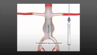 Anaconda AAA Stent Graft System  Vascutek a Terumo Company [upl. by Andi]