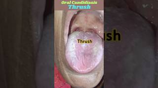 Oral CandidiasisThrushviralshortsthrush 3danimation crazypharmaguruji [upl. by Timus]