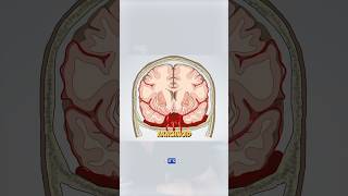 Subarachnoid hemorrhage is the result of a brain aneurysm brain brainbleed doctor medical [upl. by Attena368]