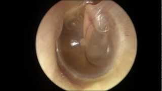 Serous Otitis Media [upl. by Rhiamon]