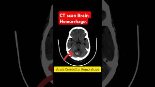 Ct brain Hemorrhage Acute hemorrhage ctscan ctbrain cthead hemorrhage acute vertigo [upl. by Atoel81]