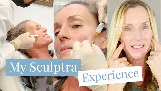 My SCULPTRA Experience  Full Treatment amp After [upl. by Adnarem]