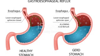 GASTROOESOPHAGEAL REFLUX DISEASE GERD  PATHOPHYSIOLOGY [upl. by Nickie]