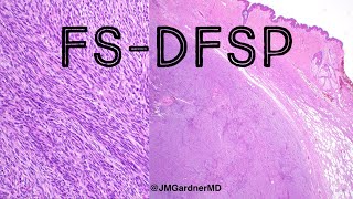 FSDFSP fibrosarcomatous dermatofibrosarcoma protuberans pathology dermpath dermatology [upl. by Eilsew]