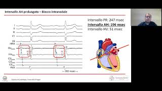 Come appare il ritmo sinusale  parametri ed intervalli di riferimento [upl. by Myranda]