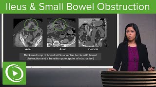 Bowel Obstruction and Ileus Ileus amp Small Bowel Obstruction – Radiology  Lecturio [upl. by Epoillac]