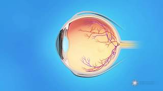 What causes a retinal tear or detachment [upl. by Aihsa275]