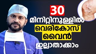 30 മിനിറ്റിനുള്ളിൽ വെരികോസ് വൈൻ ഇല്ലാതാക്കാം  VenaSeal Varicose Vein Treatment [upl. by Matazzoni]