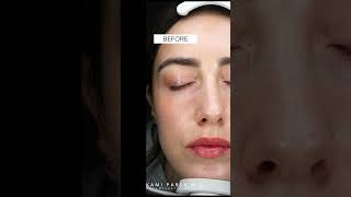 Facial Revolumization with Fat  Fat Transfer to Temples amp Cheekbones  Dr Kami Parsa [upl. by Rubi]