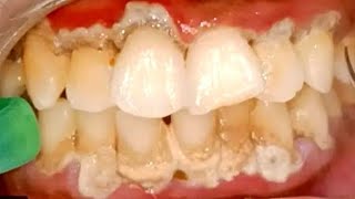 Dental Cleaning to remove heavy tartar🦷 removing tartar from teeth quot plaque removal  tartar [upl. by Hurd759]