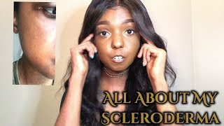 Living With Scleroderma  All about my scleroderma [upl. by Eelana24]