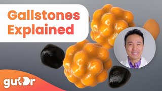 Gallstones  What Are the Causes and Symptoms  The GutDr Explains 3D Gut Animation [upl. by Ariaz]