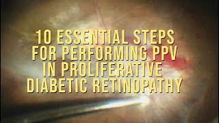 10 steps to follow in PDR surgery [upl. by Senhauser]