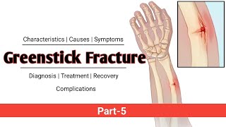 Greenstick Fracture  PART5  Explained in Hindi [upl. by Leland363]