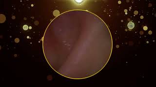 Tinnitus Jobson Horne Ear Wax Removal [upl. by Atiuqram528]