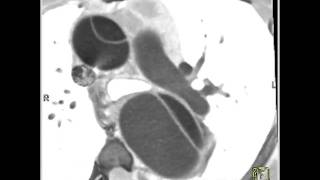 Cardiac prosthetic aortic valve 4 of 4 [upl. by Laenaj992]