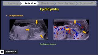 scrotal ultrasound  everything u should know  part 1 [upl. by Sirtaeb]