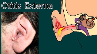 Swimmers Ear Otitis Externa Causes Diagnosis Treatment [upl. by Esenaj957]