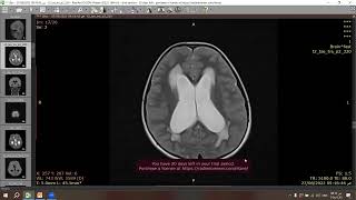 Pilocytic astrocytoma [upl. by Anyl]