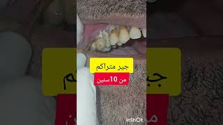 ازالة وتنظيف جير و تقليح الاسنان dentist stitch اكسبلور stitchlover ترند [upl. by Aramad]