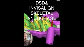 How a Facially Airway and TMJ Driven Ideal Design will guide the Orthodontic Treatment [upl. by Hesta]