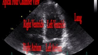 Echocardiogram Inspiratory Lung Interference Examples [upl. by Eggleston]