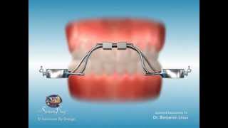 ScreenPlay Orthodontic Education Videos Rapid Palatal Expander RPE [upl. by Adneral]