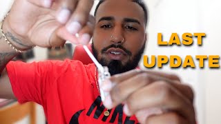 FINAL UPDATE Closing My Stretched Ears With TCA Acid  NO SURGERY [upl. by Analihp]