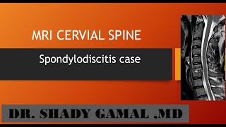 5MRI Cervical spine inflammation spondylodiscitis [upl. by Flori]