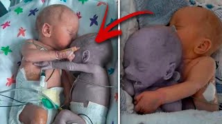 Mom puts the baby to the dying Twin and five minutes later a real Miracle happens [upl. by Annayram797]