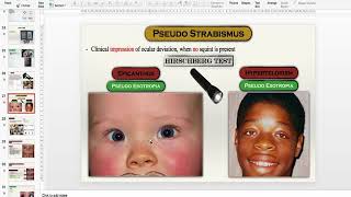 Ophthalmology in a nutshell Squint [upl. by Suzanne]