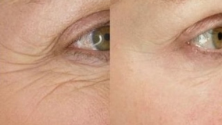 Smooth Eye Wrinkles With This Easy 5 Minute Face Massage [upl. by Mavra]