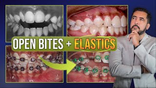 Anterior OPEN BITE  Elastics [upl. by Edi563]