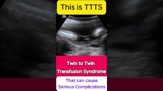 TTTS  Twin to Twin Transfusion Syndrome Ultrasound  Monochorionic TWINS [upl. by Jehu]