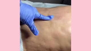 Fibrosis Treatment after liposuction [upl. by Marigold]