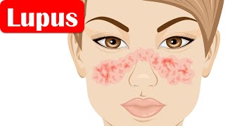 Lupus SLESystemic Lupus Erythematosus  Causes Pathogenesis Symptoms Diagnosis Treatment [upl. by Llehcar]