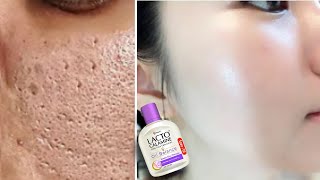 How to use Lacto Calamine Lotion  Lacto Calamine Lotion For Clear Spotless Brighten Skin [upl. by Ottavia]