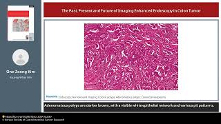 The Past Present and Future of Imaging Enhanced Endoscopy in Colon Tumor [upl. by Aleydis636]