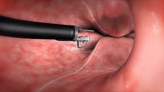 What Happens During the Endoscopic Sleeve Gastroplasty ESG Procedure [upl. by Llenrahs]