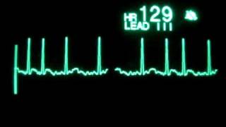 Atrial Fibrillation with RVR [upl. by Ardine]