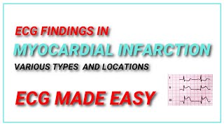 Myocardial Infarction ECG Changes [upl. by Ezirtaeb599]