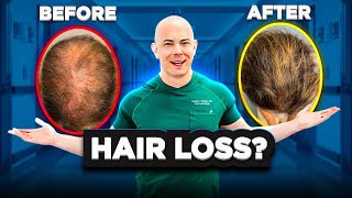 Oral Minoxidil For Hair Loss What You Need to Know [upl. by Viglione]