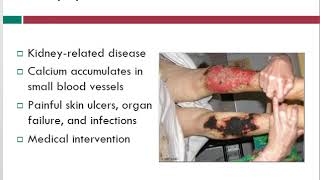 Calciphylaxis  Wound Care Topics  Free Wound Care Info  WoundEducatorscom [upl. by Eimmis]