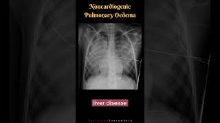 Noncardiogenic Pulmonary Edema Differential Diagnosis shorts radiologyshorts [upl. by Arley]