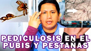 COMO ELIMINAR LA PEDICULOSIS EN EL PUBIS Y PESTAÑAS [upl. by Bennie]