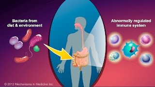 What is Crohns Disease [upl. by Boni]